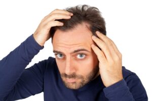 Tóc rụng nhiều ở nam: Top 5 Nguyên nhân và bí quyết ngăn ngừa hiệu quả