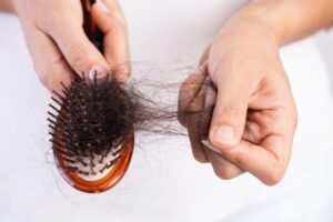 Tóc rụng nhiều là bị gì? Đừng chủ quan nếu có dấu hiệu này