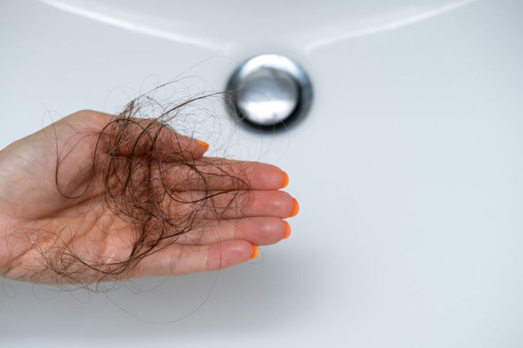 Rụng tóc nhiều bị bệnh gì? Cảnh báo sức khỏe